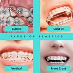 How Do Elastics Work Braces?