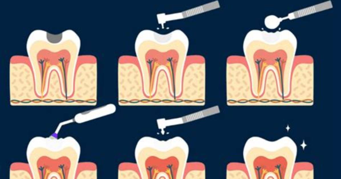 How Do Fillings Work?