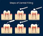 How Do Fillings Work?
