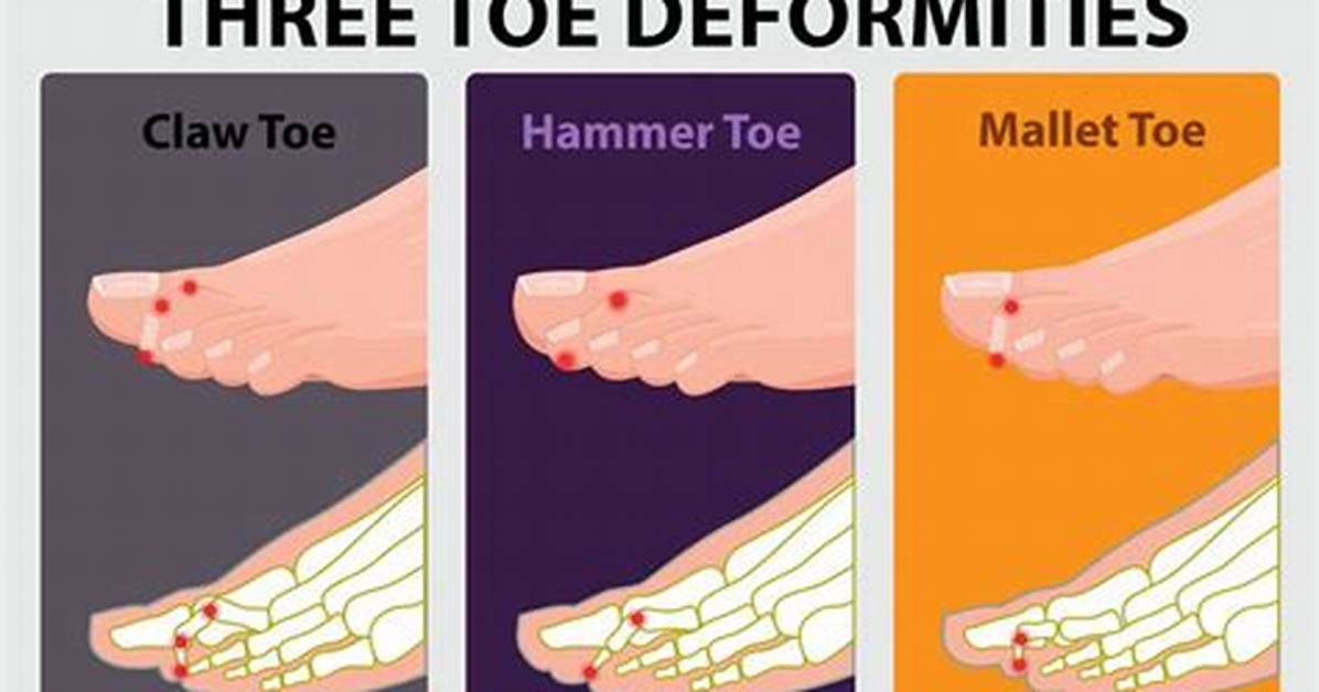 How Do Hammertoes Develop?