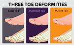 How Do Hammertoes Develop?