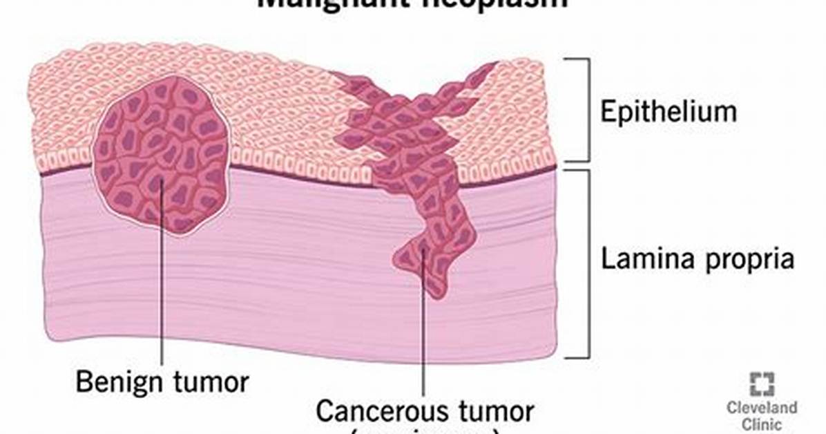 How Do Neoplasms Spread?