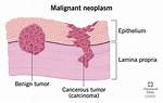 How Do Neoplasms Spread?