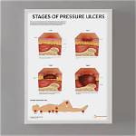 How Do Pressure Ulcers Form