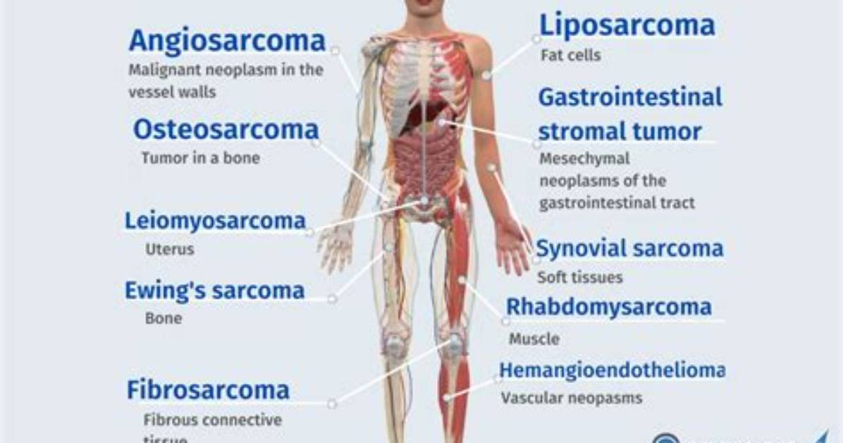 How Do Sarcomas Form?