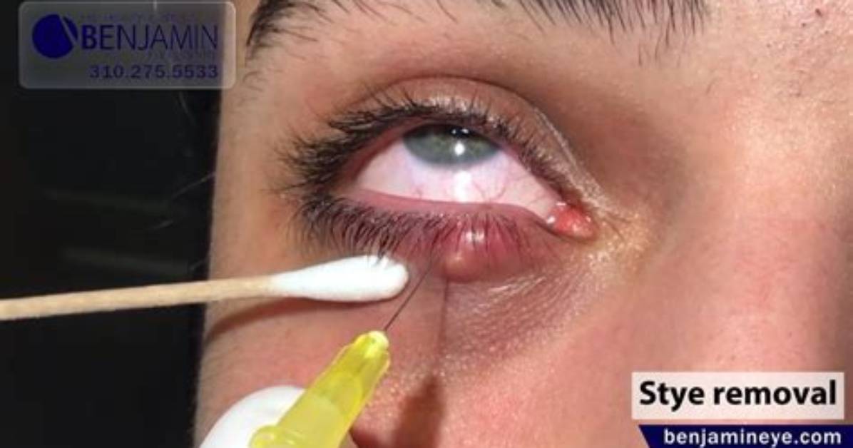 How Do Styes Drain?