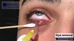 How Do Styes Drain?