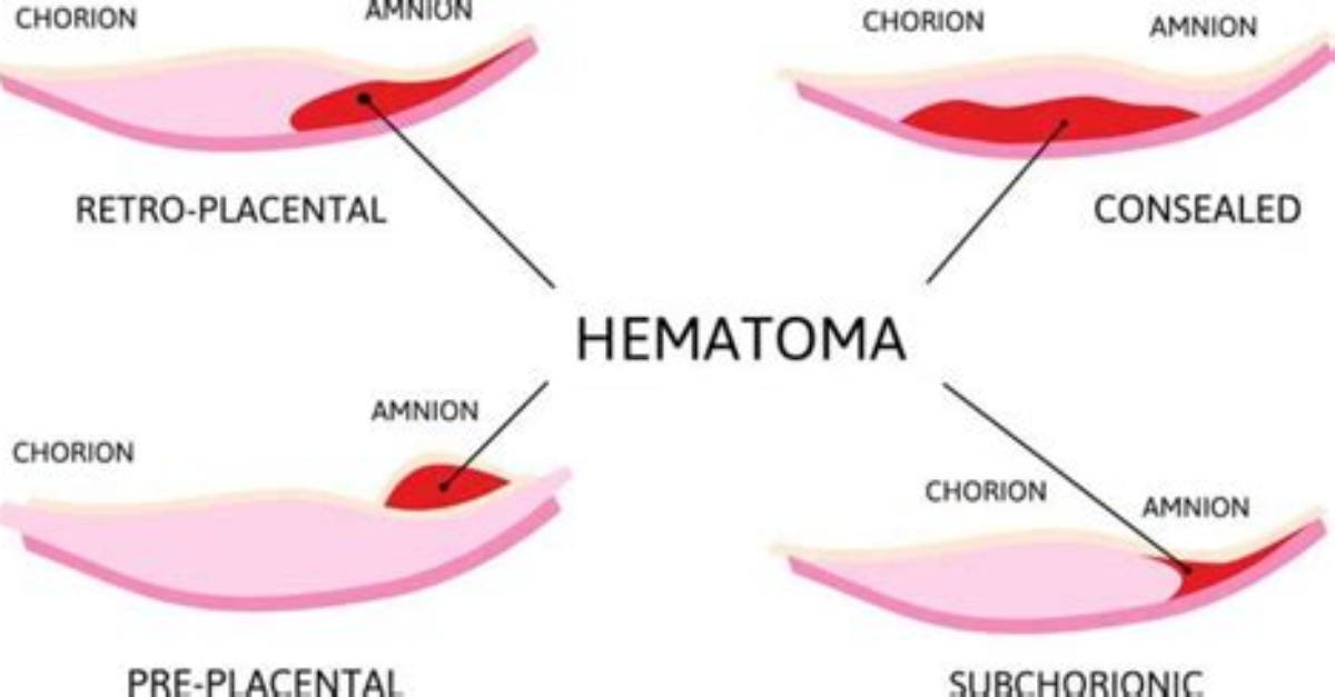 How Do Subchorionic Hematomas Heal?