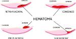 How Do Subchorionic Hematomas Heal?