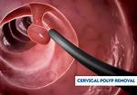 How Do They Remove a Cervical Polyp? Check This out | Cervical Polyp Removal Cpt