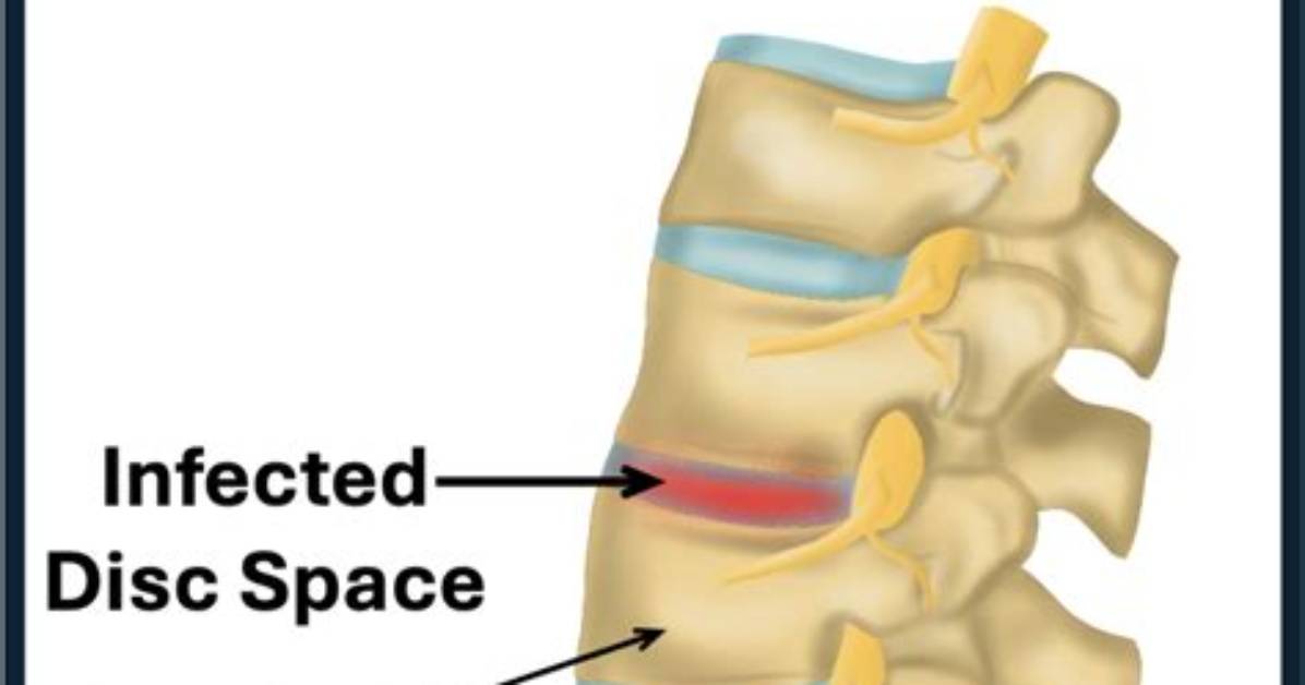 How Do U Get Discitis?