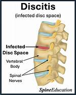 How Do U Get Discitis?