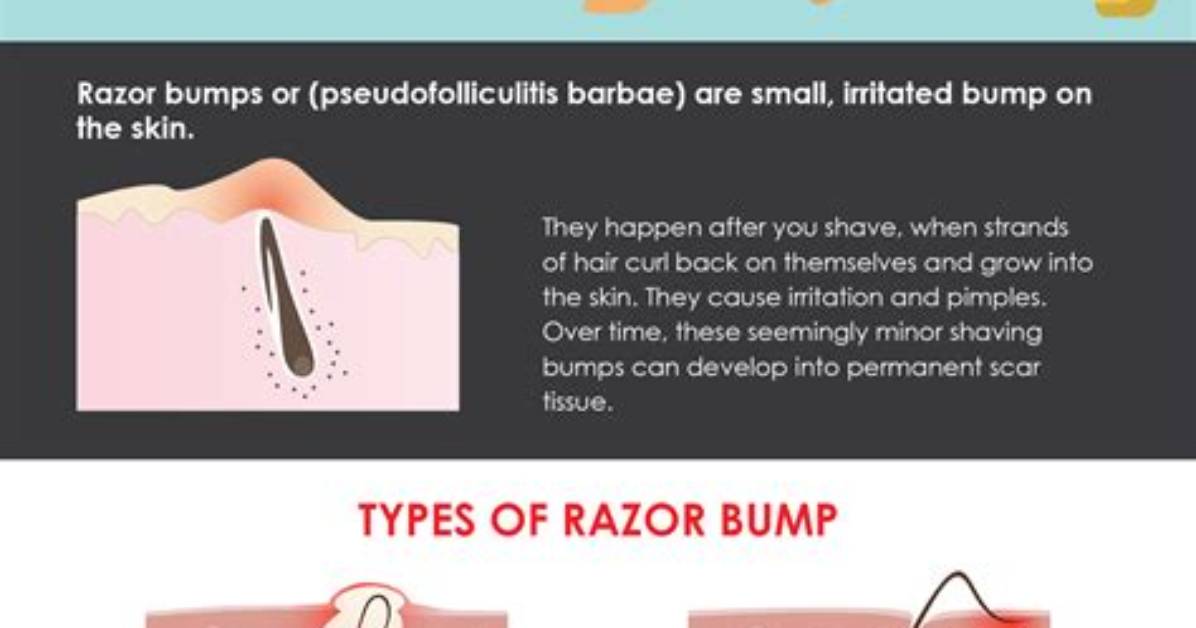 How Do You Avoid Razor Bumps?