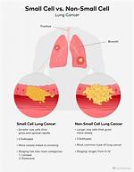 How Do You Code Non Small Cell Lung Cancer