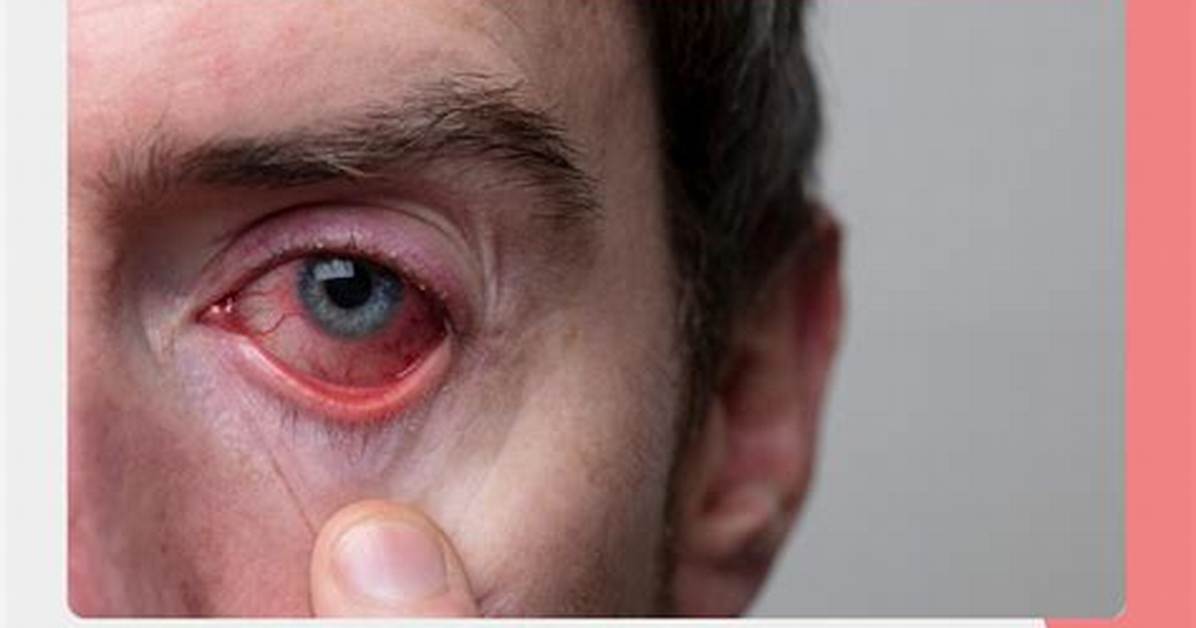 How Do You Code Pink Eye