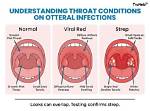 How Do You Code Strep Throat