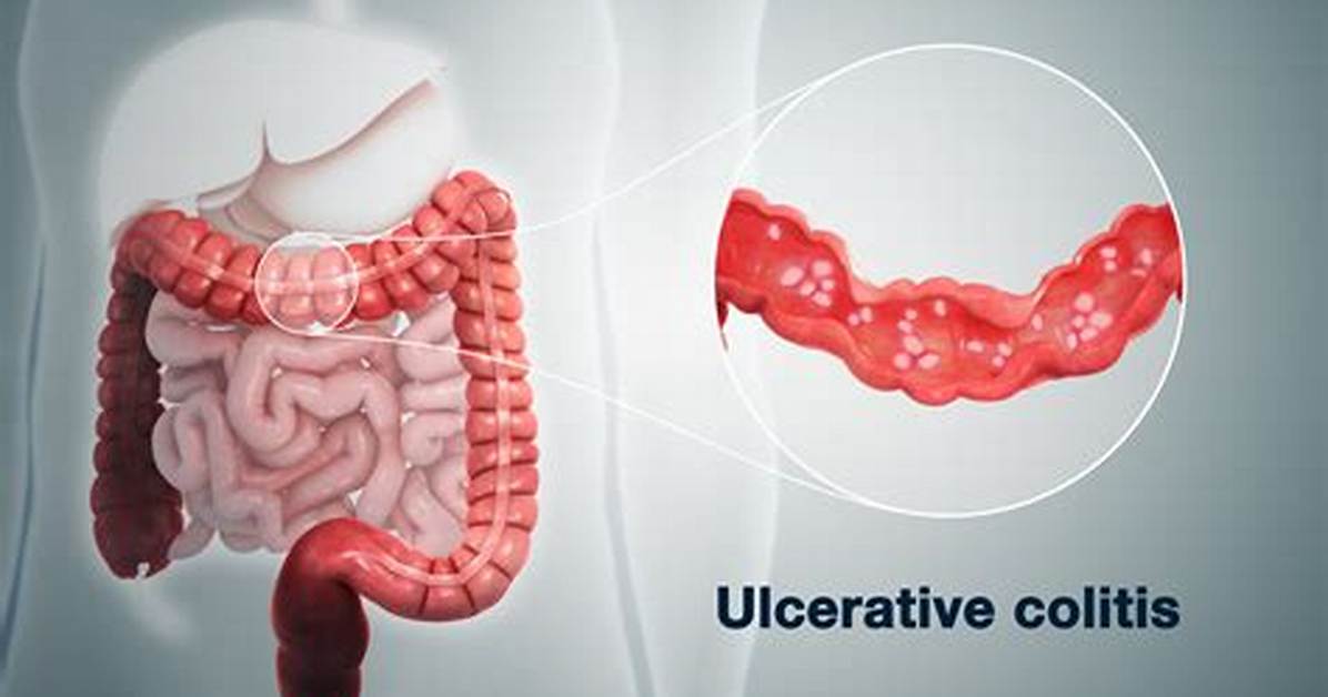 How Do You Get Colitis?