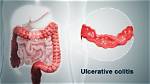 How Do You Get Colitis?