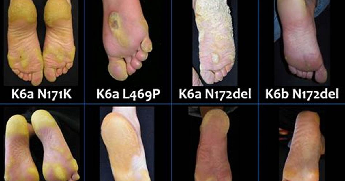 How Do You Get Keratoderma