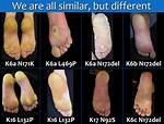 How Do You Get Keratoderma