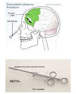 How Do You Lobotomy?