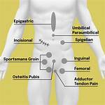 How Do You Push a Groin Hernia Back in?