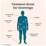 How Do You Spell Intertriginous?