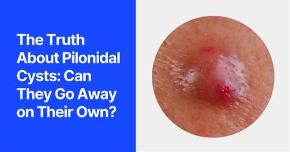 How Do You Spell Pilonidal?