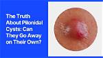 How Do You Spell Pilonidal?