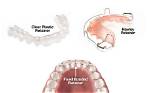 How Do You Store Retainers?