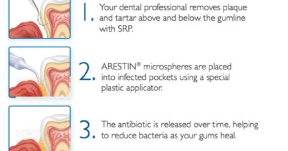 How Do You Use Arestin