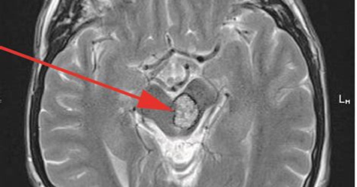 How Does a Cavernoma Form?