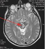 How Does a Cavernoma Form?