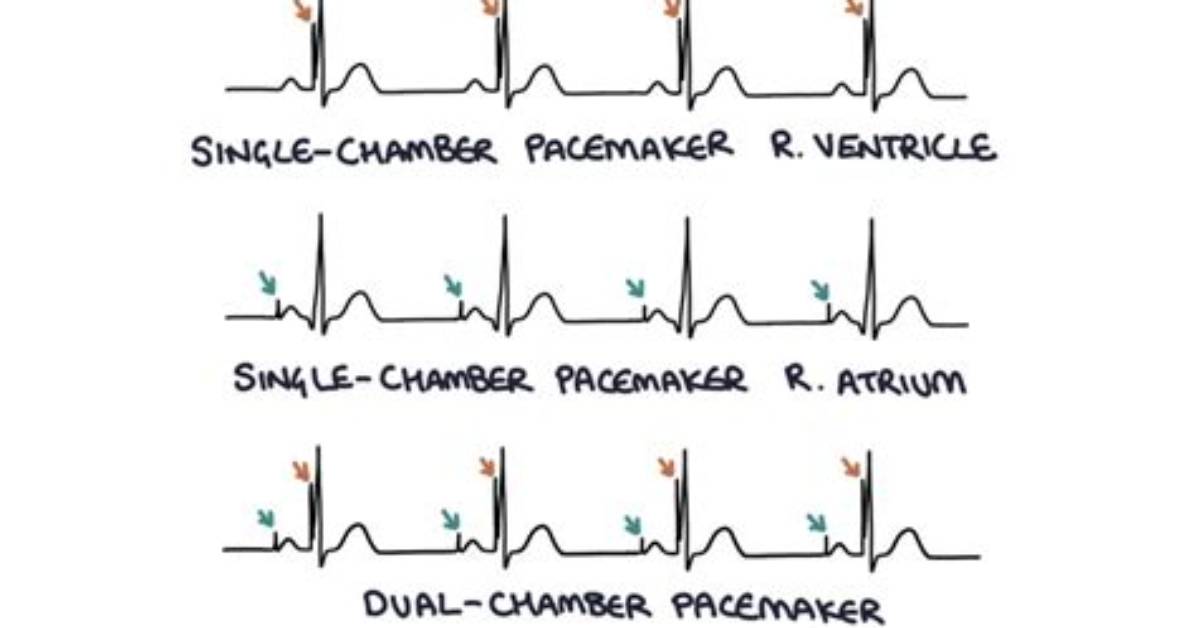How Does a Pacemaker Affect an Ecg