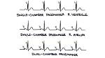 How Does a Pacemaker Affect an Ecg