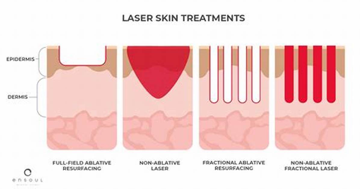 How Does Ablative Laser Work?