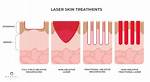 How Does Ablative Laser Work?