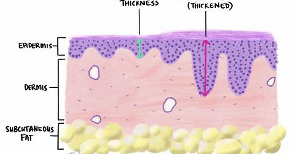 How Does Acanthosis Develop?