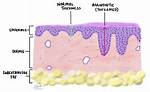 How Does Acanthosis Develop?