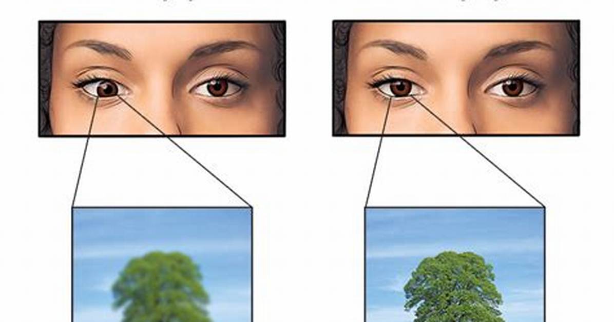 How Does Amblyopia Affect Vision?
