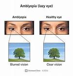 How Does Amblyopia Affect Vision?