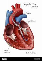 How Does an Impella Work
