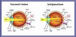 How Does Astigmatism Affect Vision