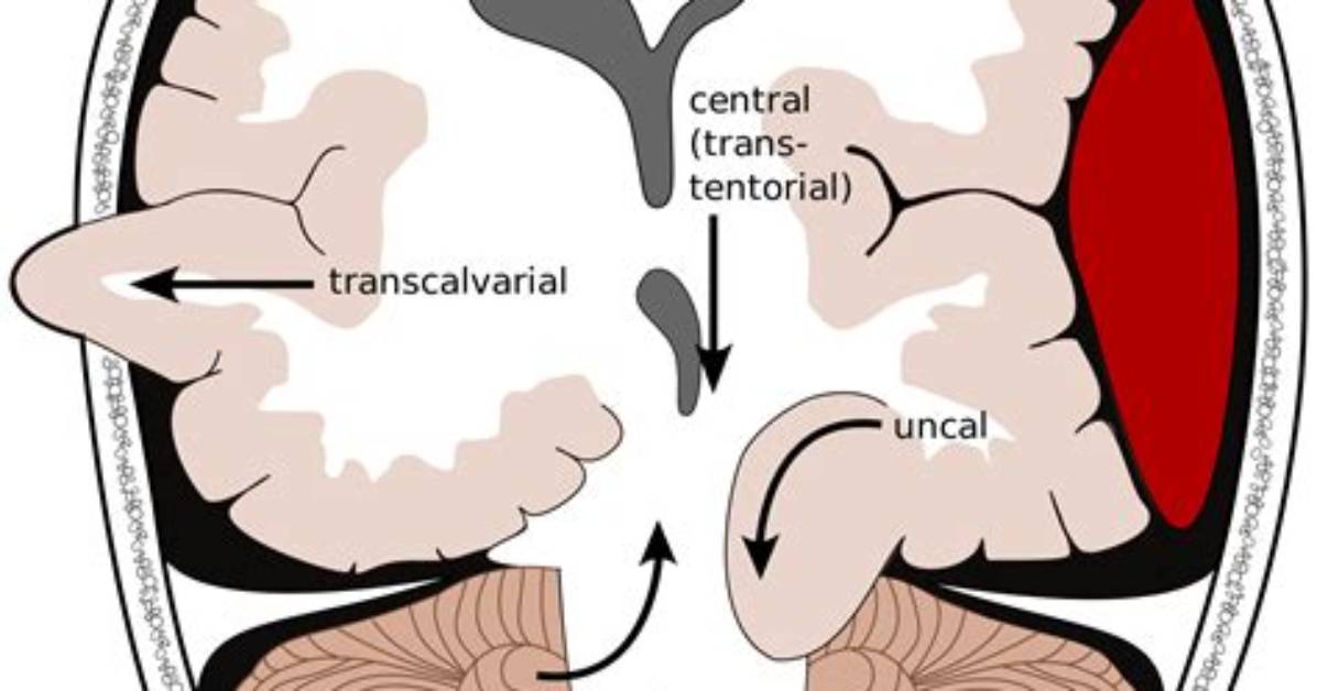 How Does Brain Herniation Occur?