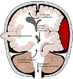 How Does Brain Herniation Occur?