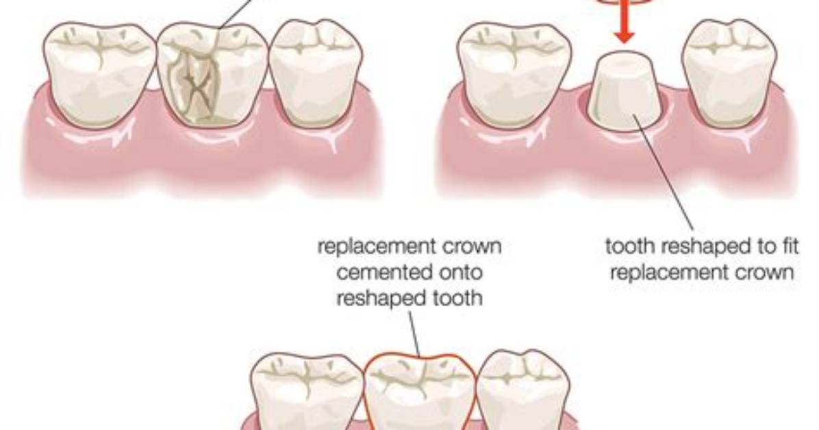How Does Capping a Tooth Work?