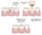How Does Capping a Tooth Work?