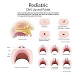 How Does Cleft Palate Affect Speech