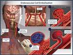 How Does Coil Embolization Work?