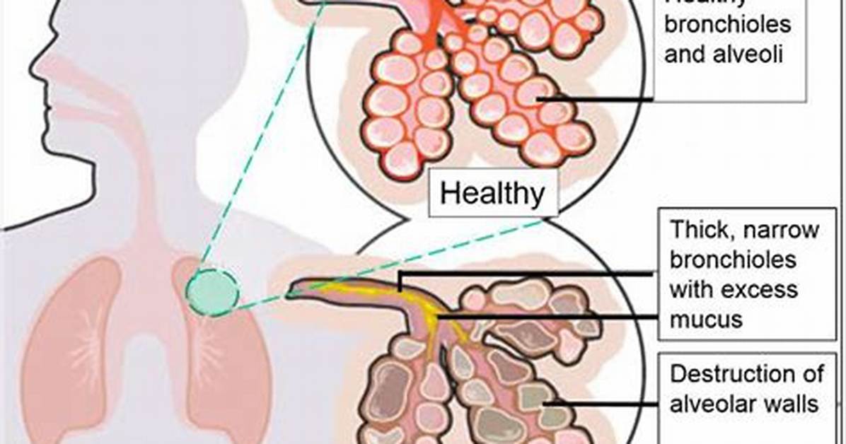 How Does Copd Affect Co2